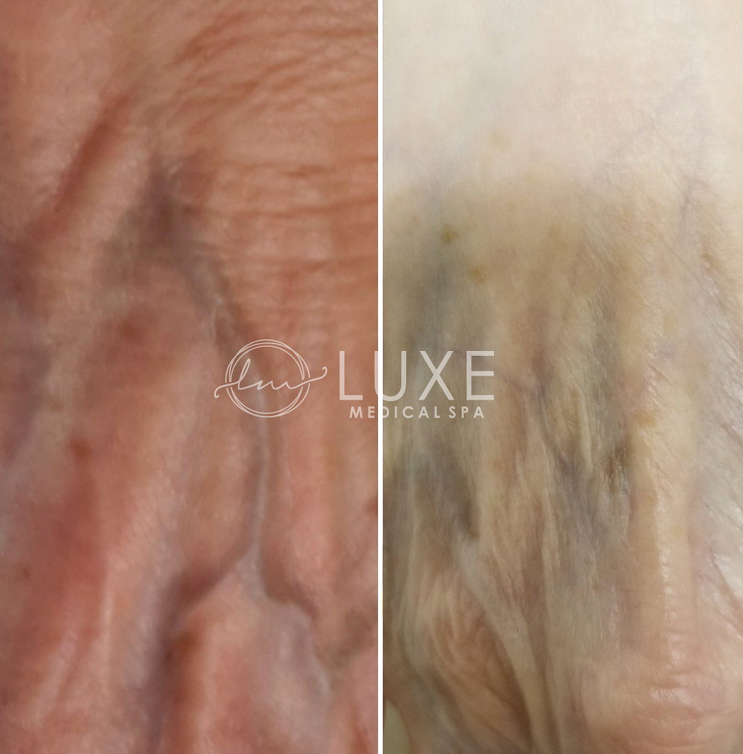 vein-treatments-sclerotherapy