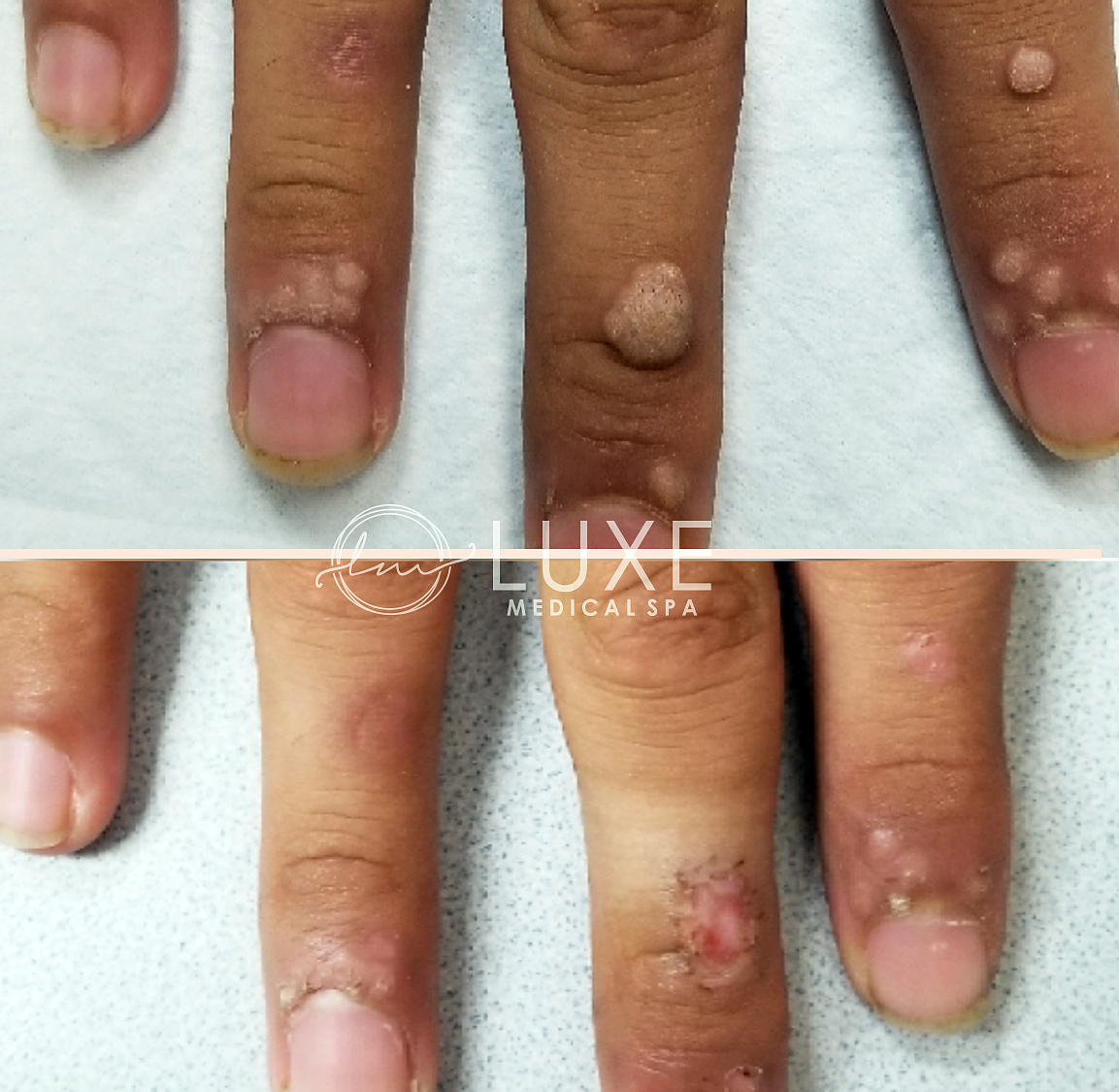 wart-removal