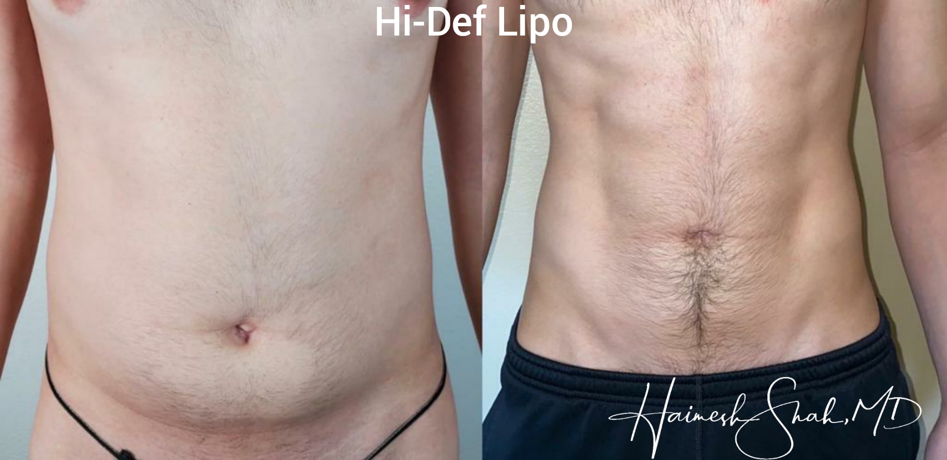 liposuction surgery