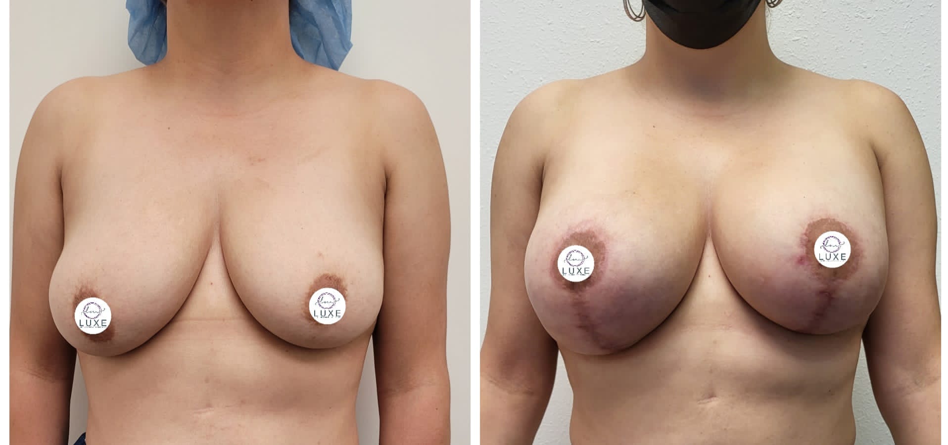 best breast lift ventura