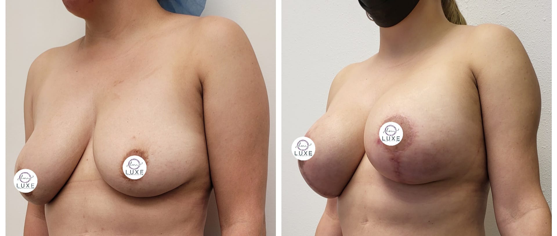 best breast lift ventura