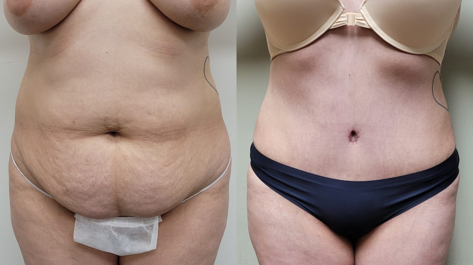 liposuction surgery
