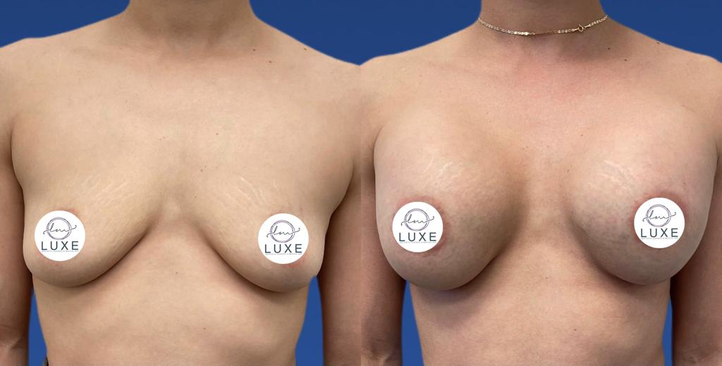 best breast augmentation doctor camarillo