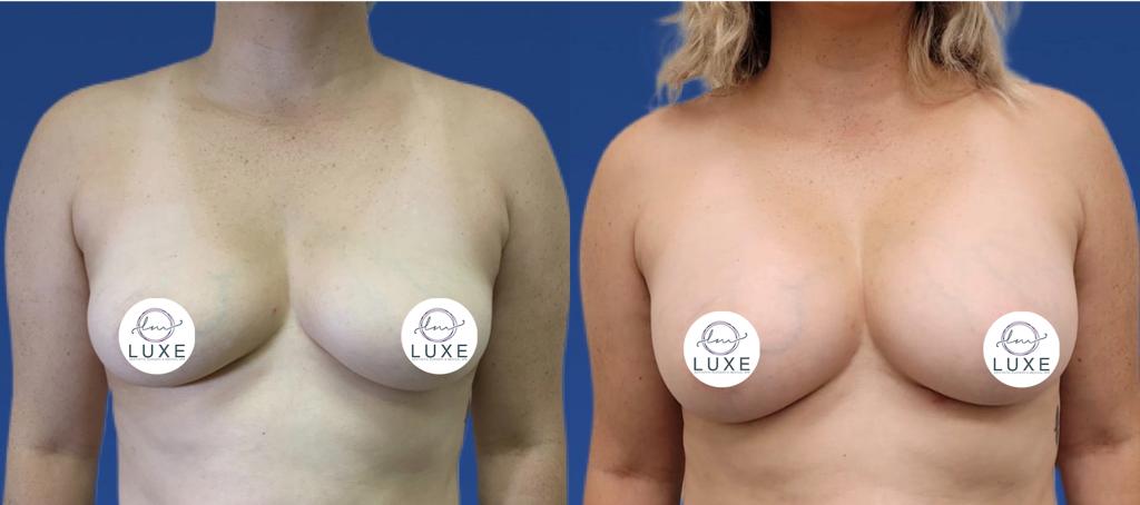 best breast augmentation doctor camarillo