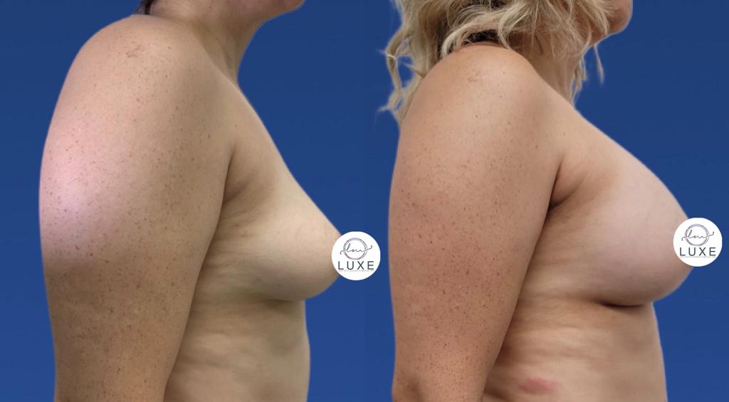 best breast augmentation surgery camarillo