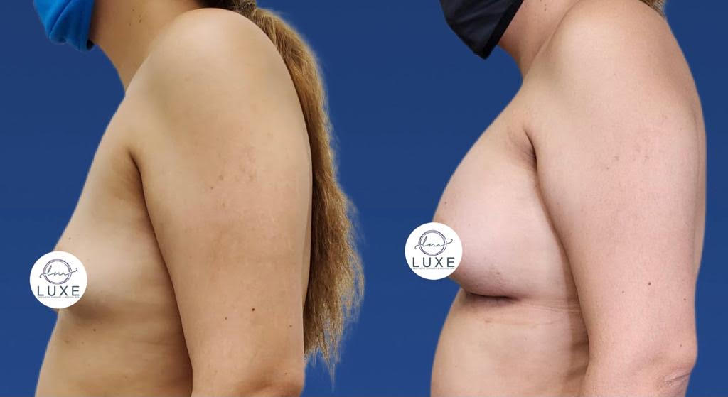 top breast augmentation camarillo