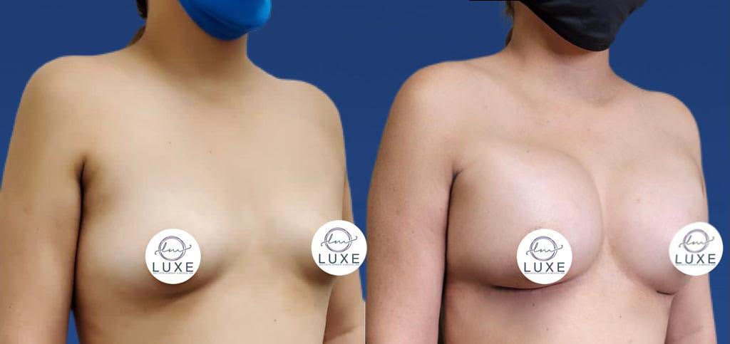top breast augmentation simi valley