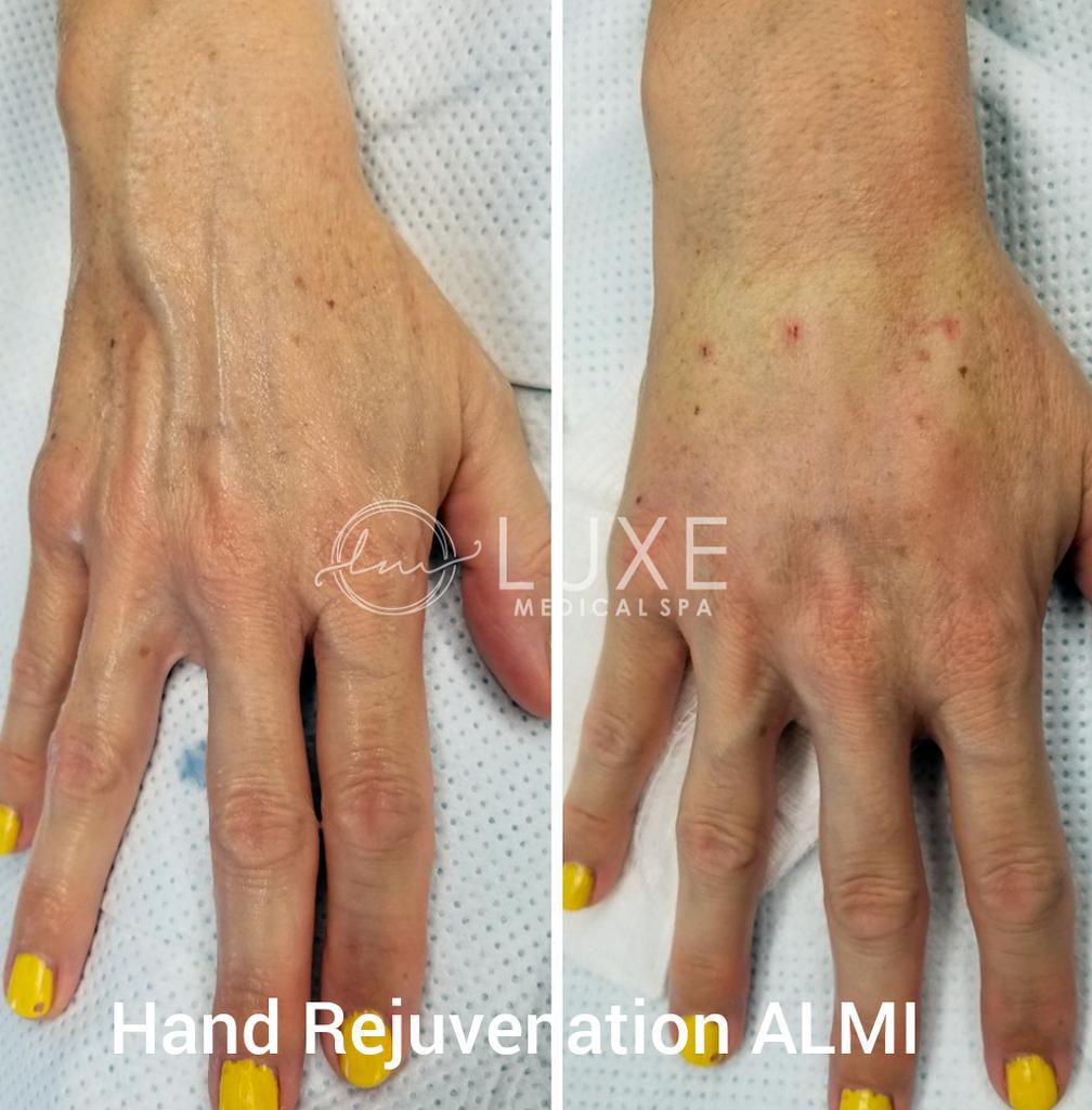 hand-rejuvenation treatment