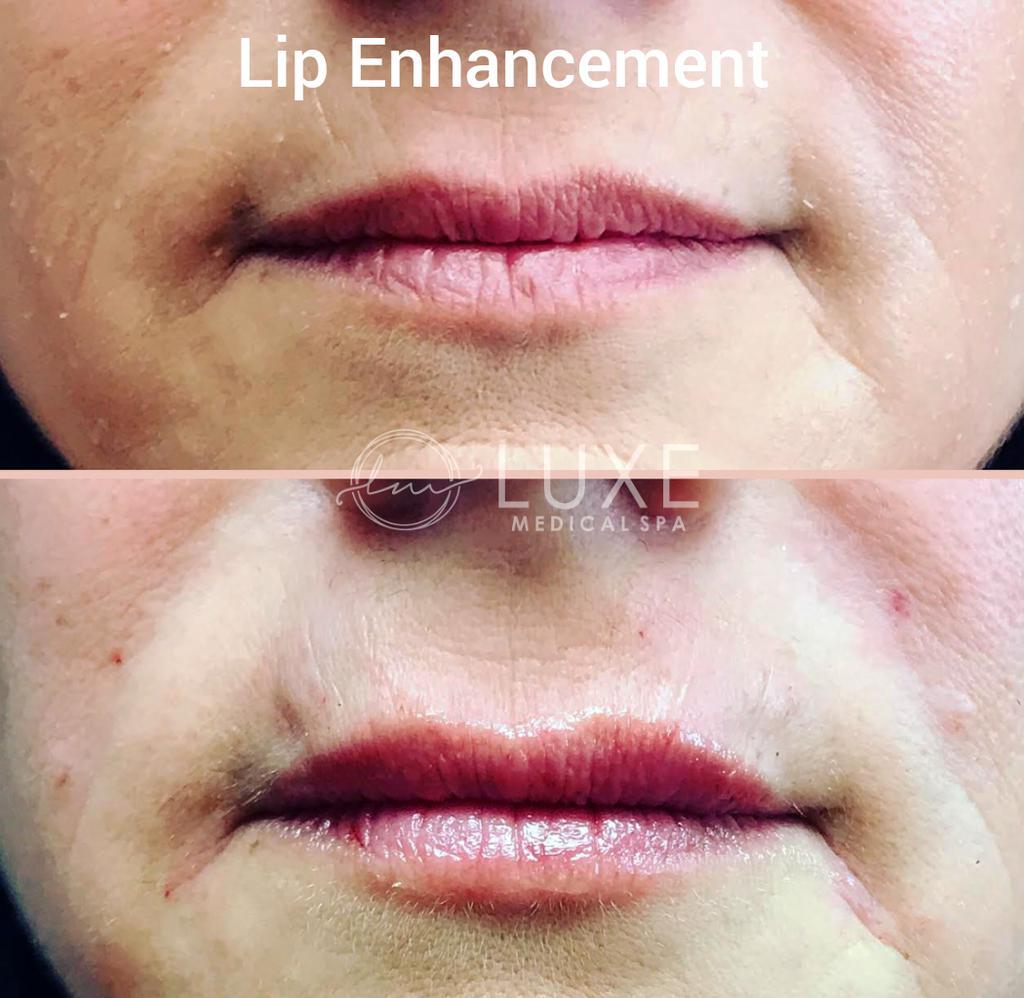 lip injection surgery