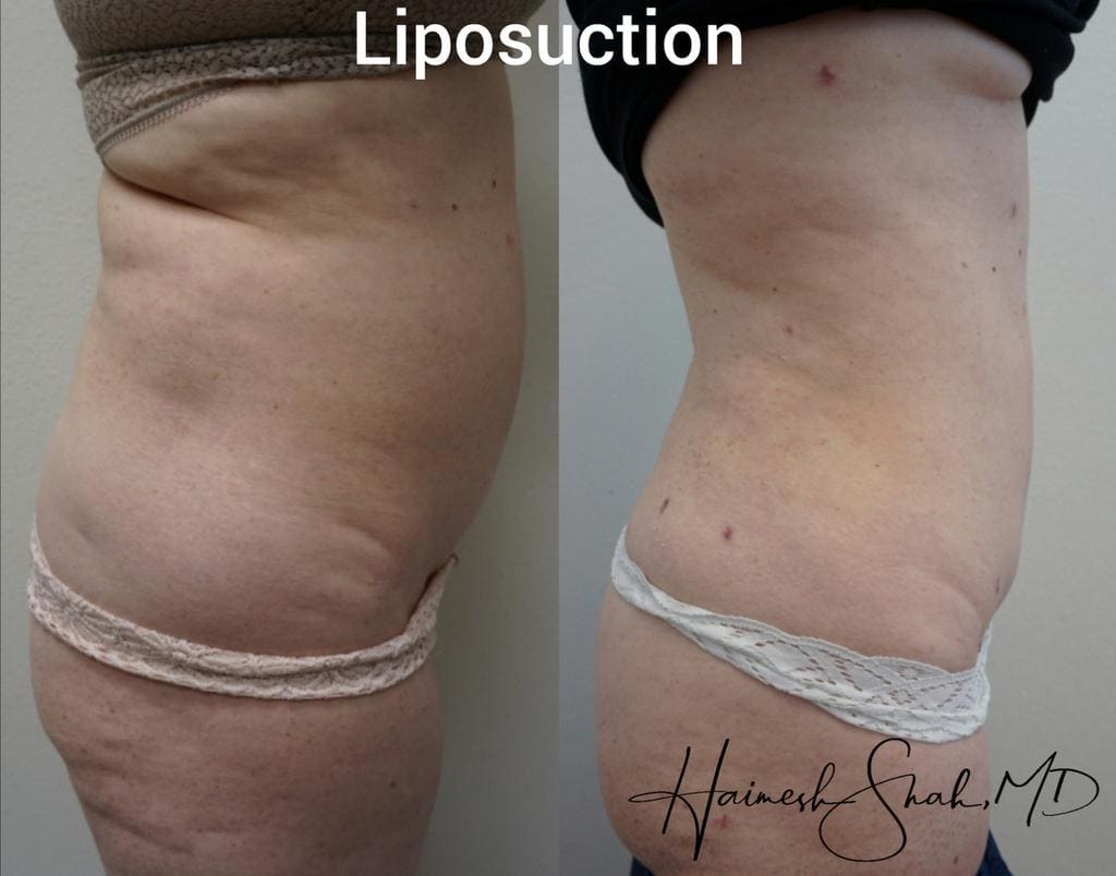 top liposuction treatment surgery
