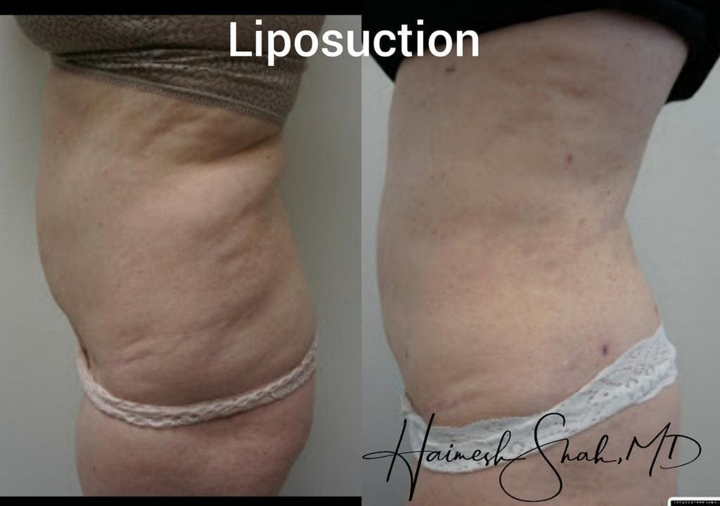 best liposuction treatment surgery