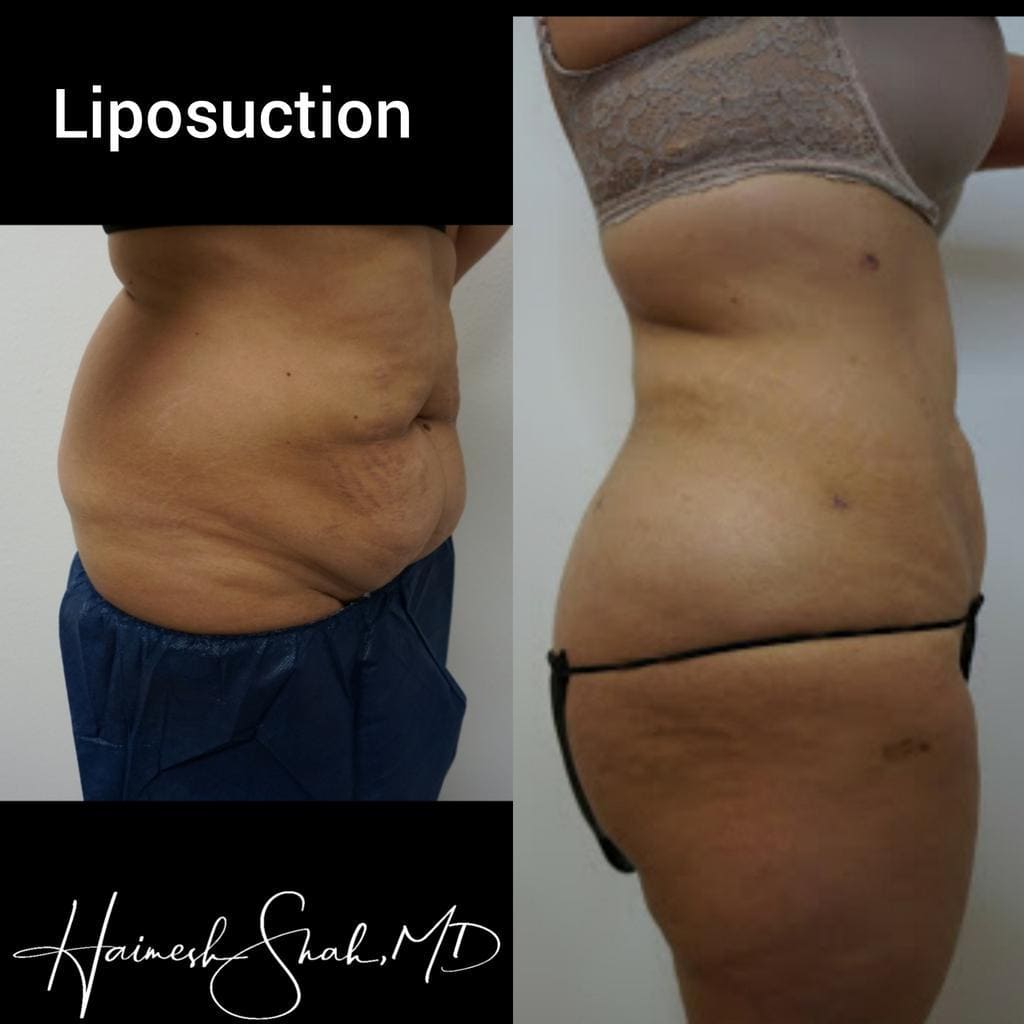 liposuction best treatment surgery in Oxnard