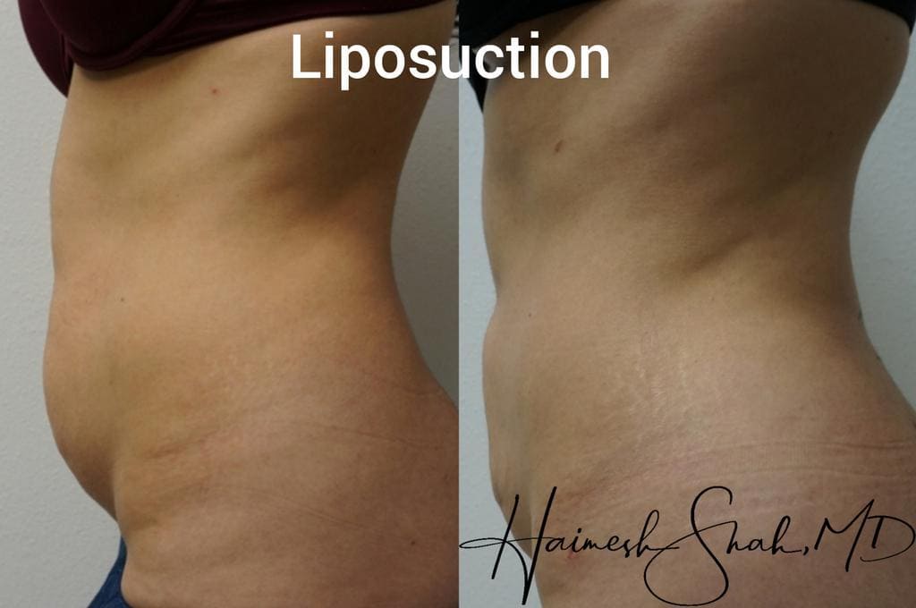 liposuction treatment surgery