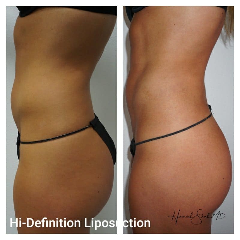 liposuction photo