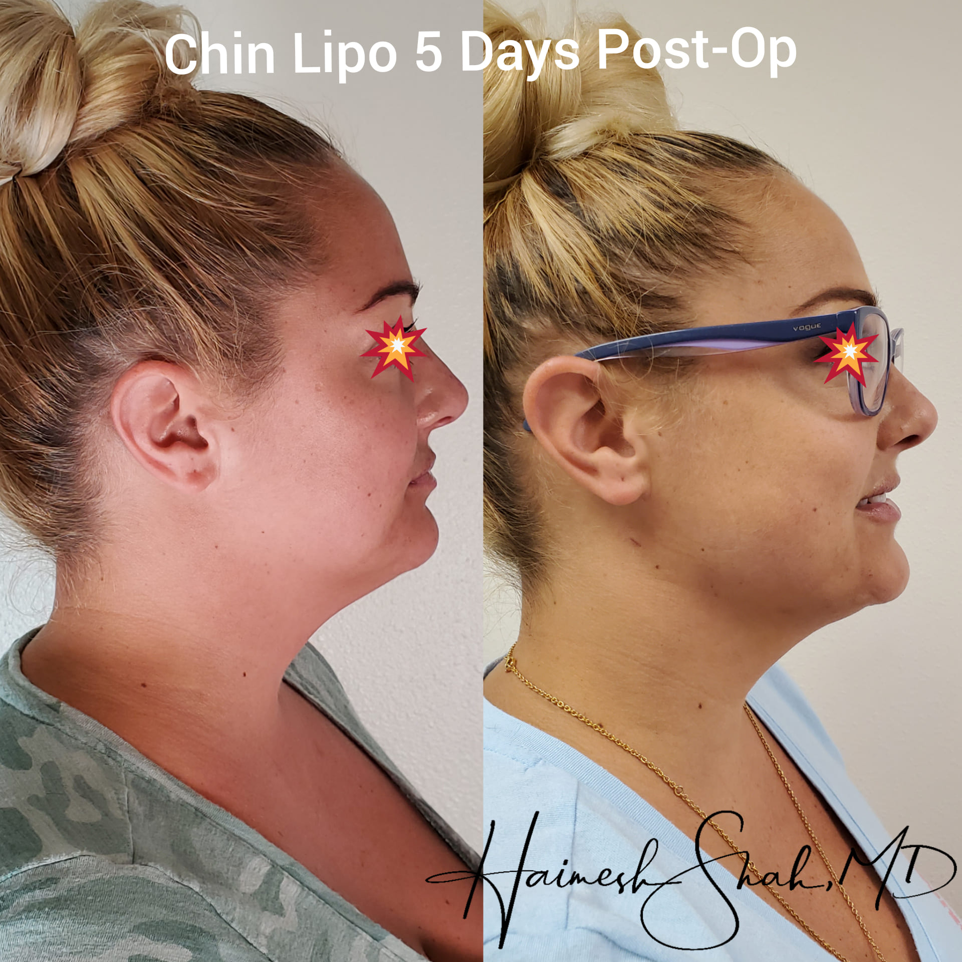 lipo before after