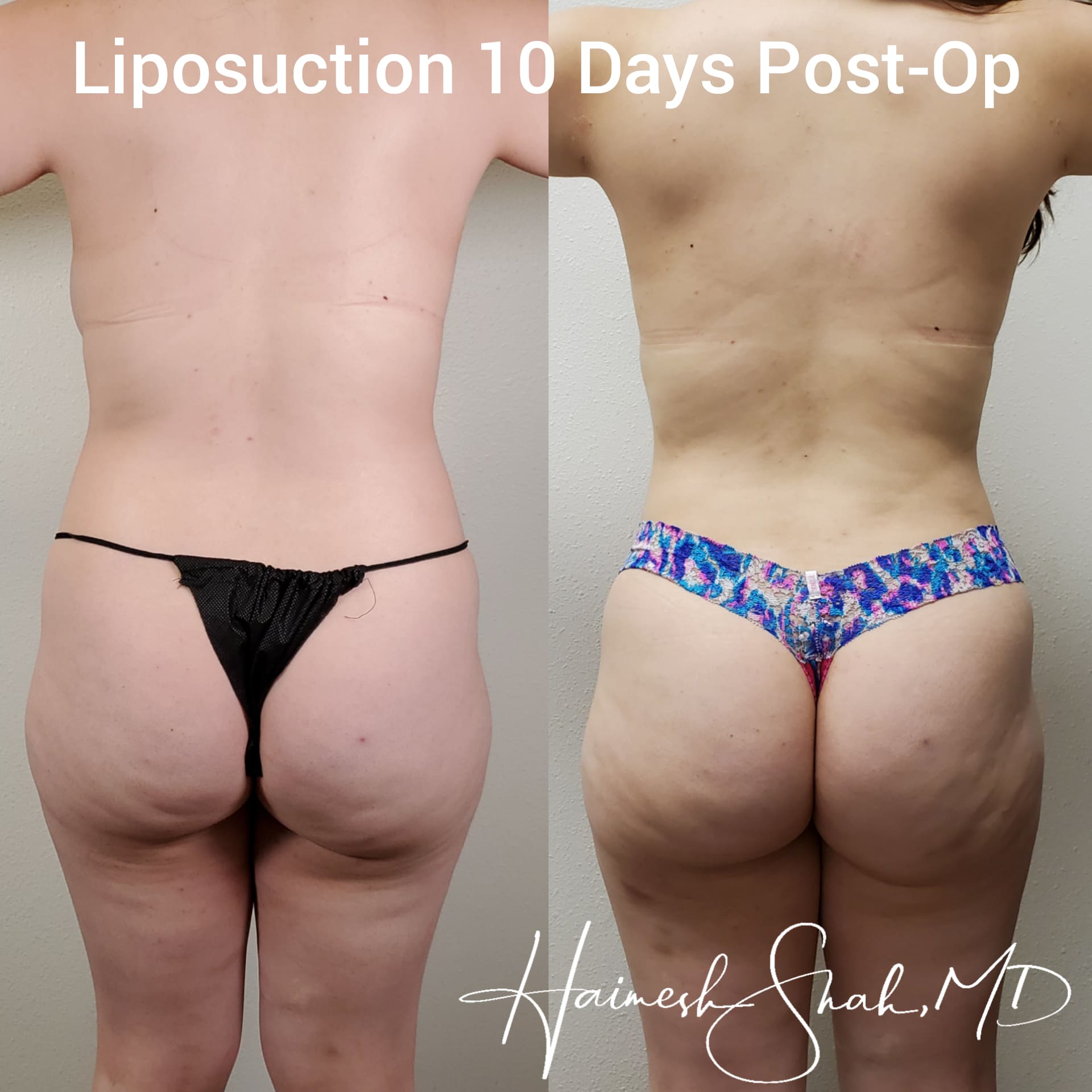 liposuction top treatment surgeon