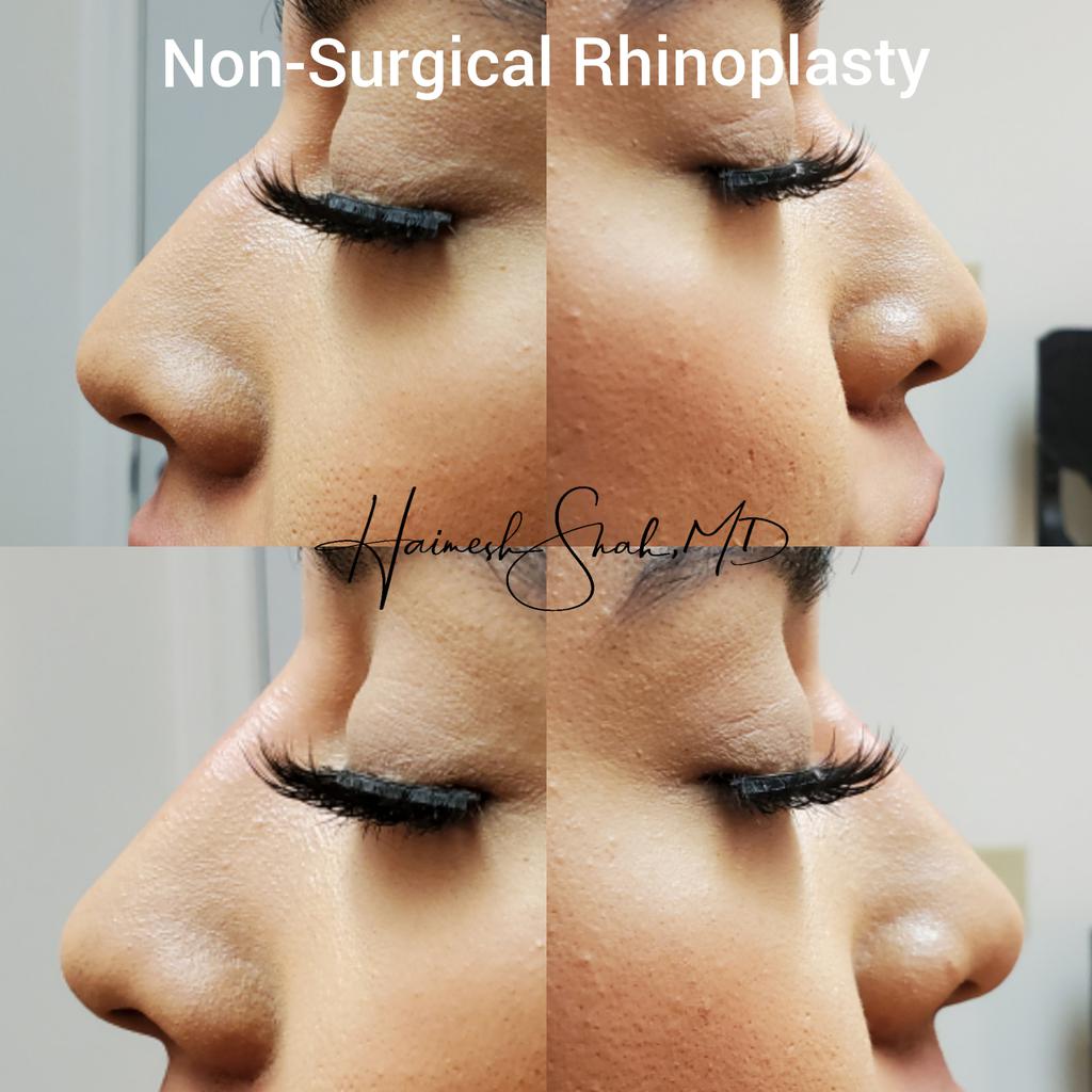 non surgical rhinoplasty