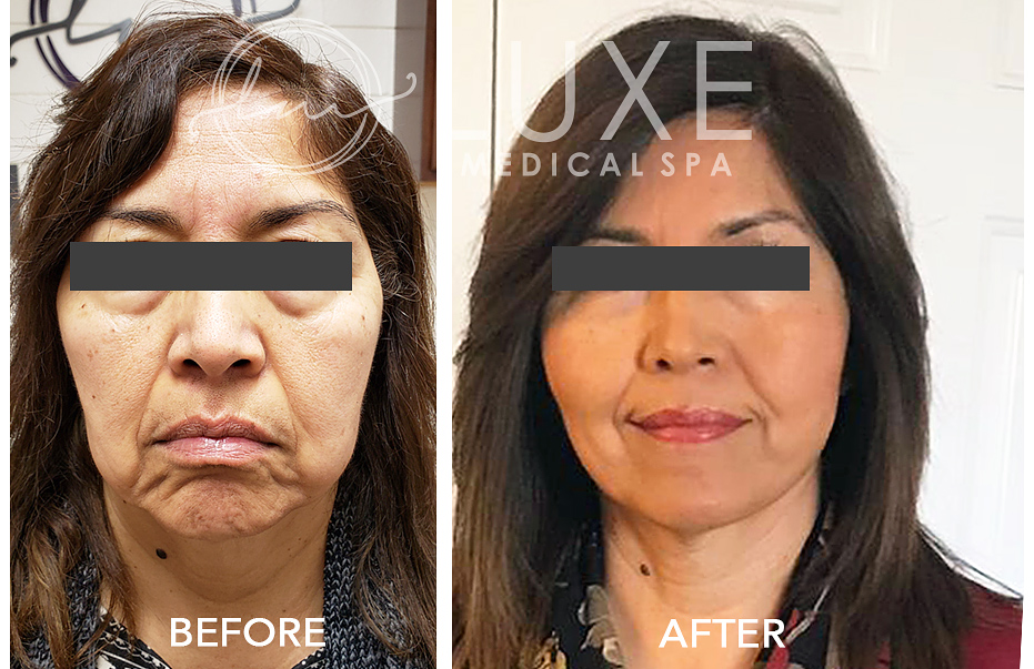 Thread Lifting: The Non-Surgical Face Lift