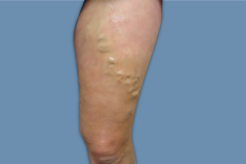 Vein Removal Los Angeles  Best Treatment for Varicose Veins