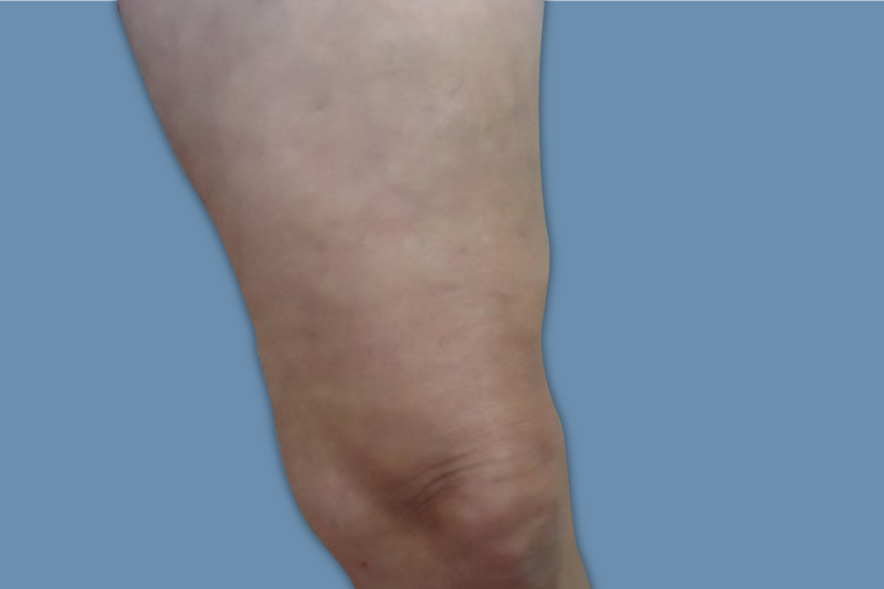 Varicose Vein Removal, Sclerotherapy & Microphlebectomy in Oxnard, CA | Veins Treatment