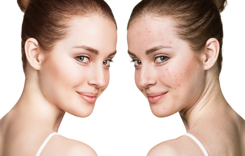 Acne Laser Treatment in Oxnard, CA