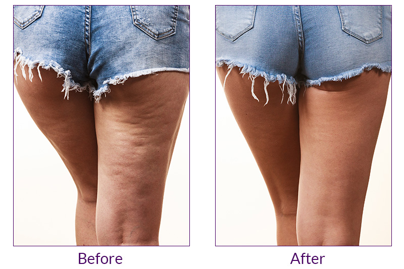 Reduce Cellulite And Improve Skin