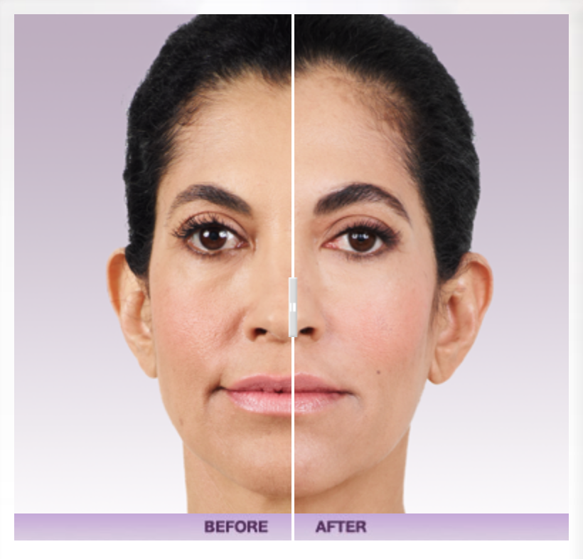 Juvederm Ultra Before & After