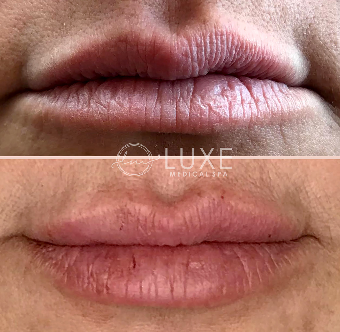 Lip Enhancements Ventura County