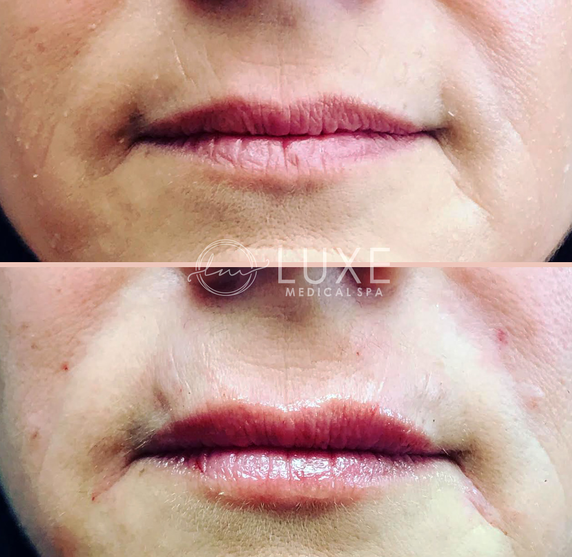 Lip Enhancements Ventura County