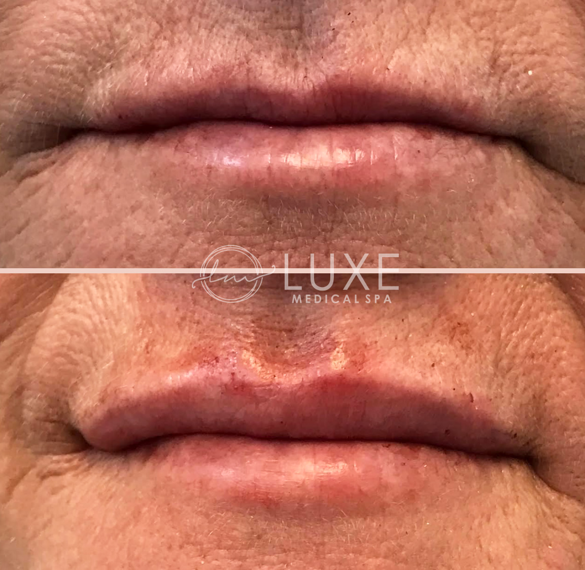 Lip Enhancements Ventura County