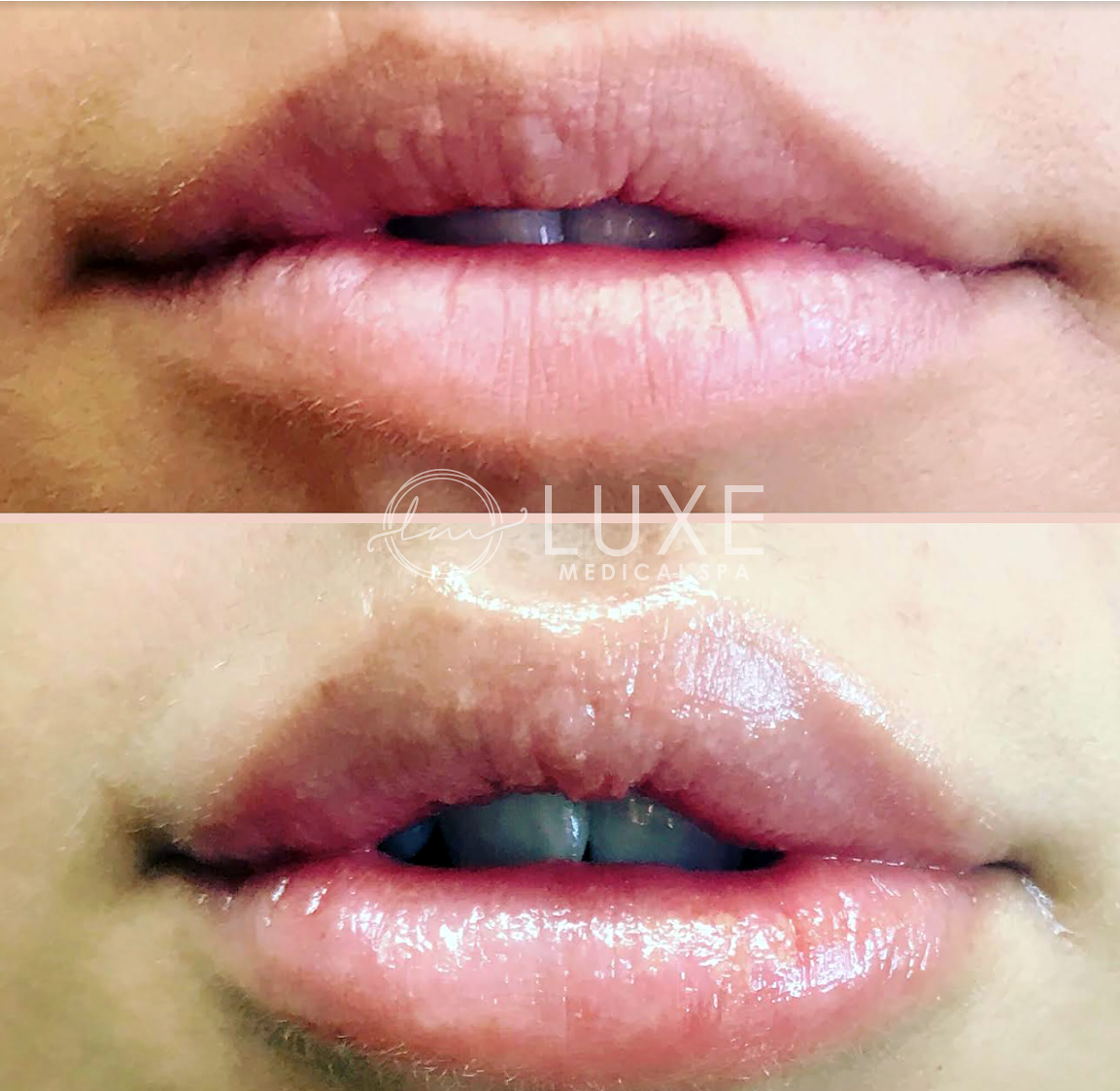 Lip Enhancements Ventura County