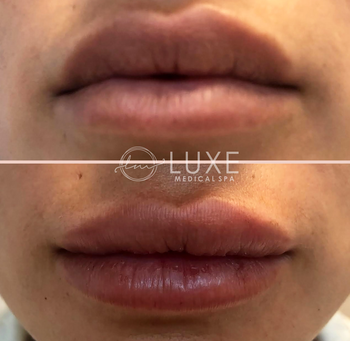 Lip Enhancements Ventura County