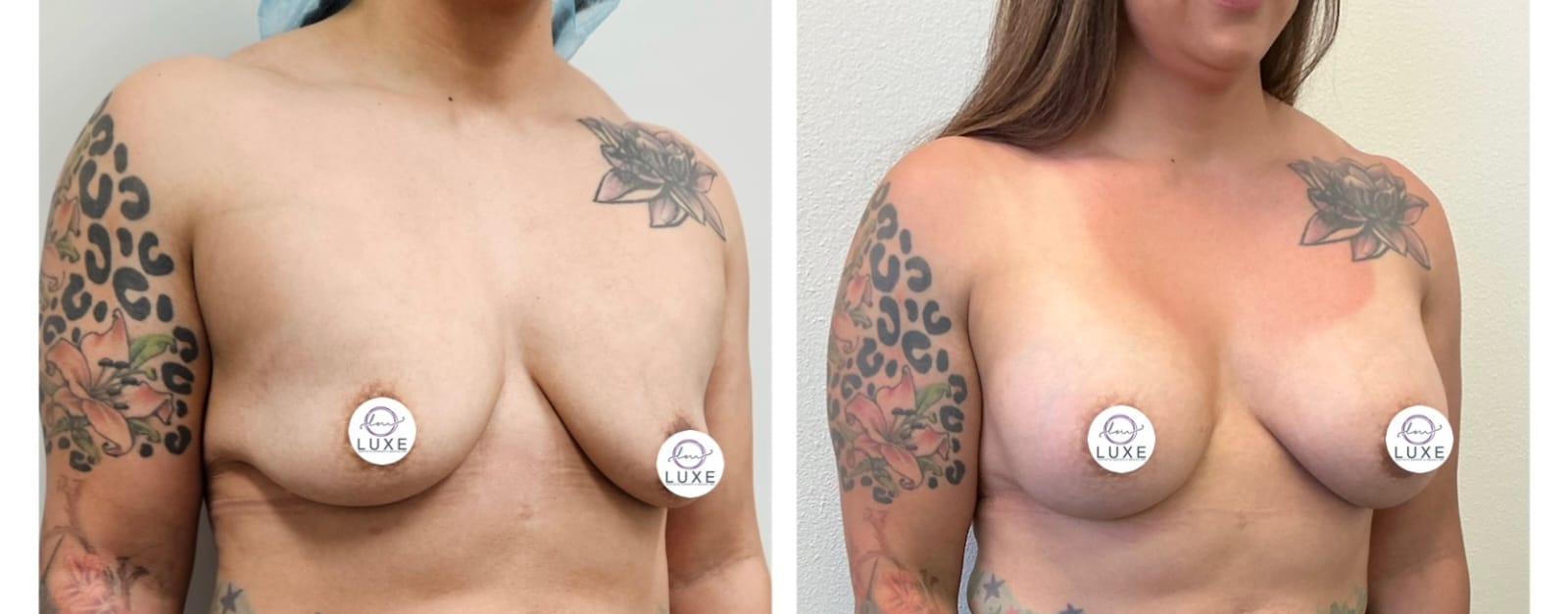 best breast augmentation before after results 2024