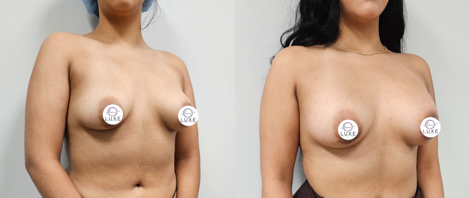 best breast augmentation before after results 2024