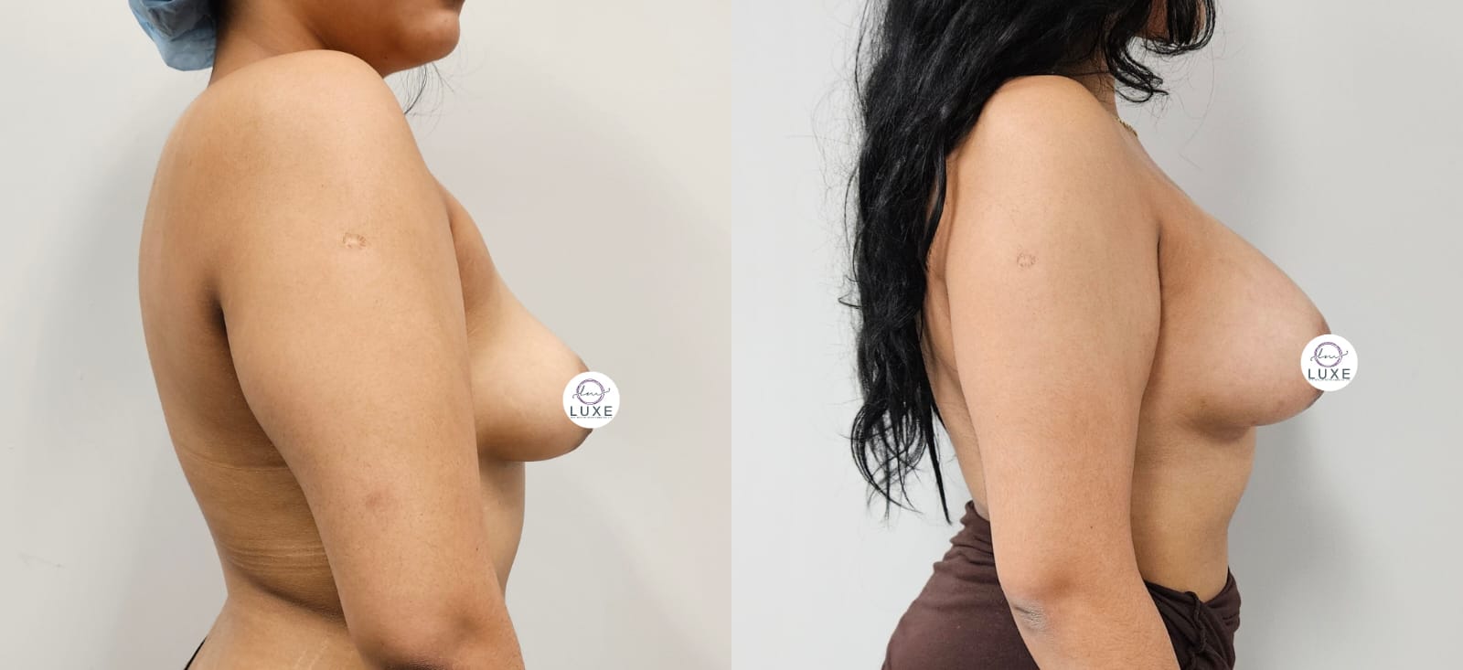 best breast augmentation before after results 2024