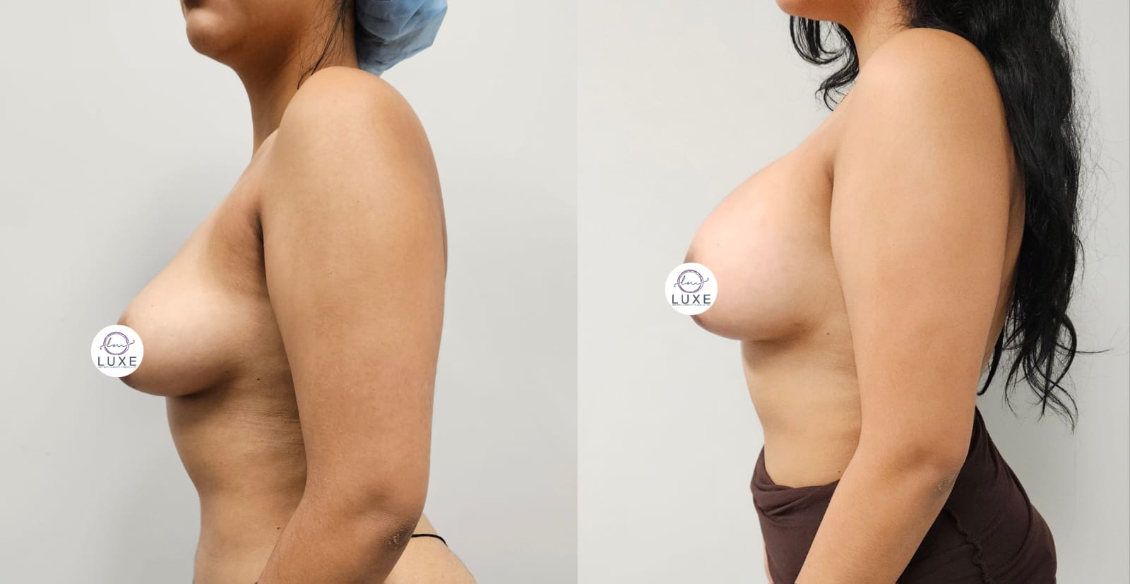 best breast augmentation before after results 2024