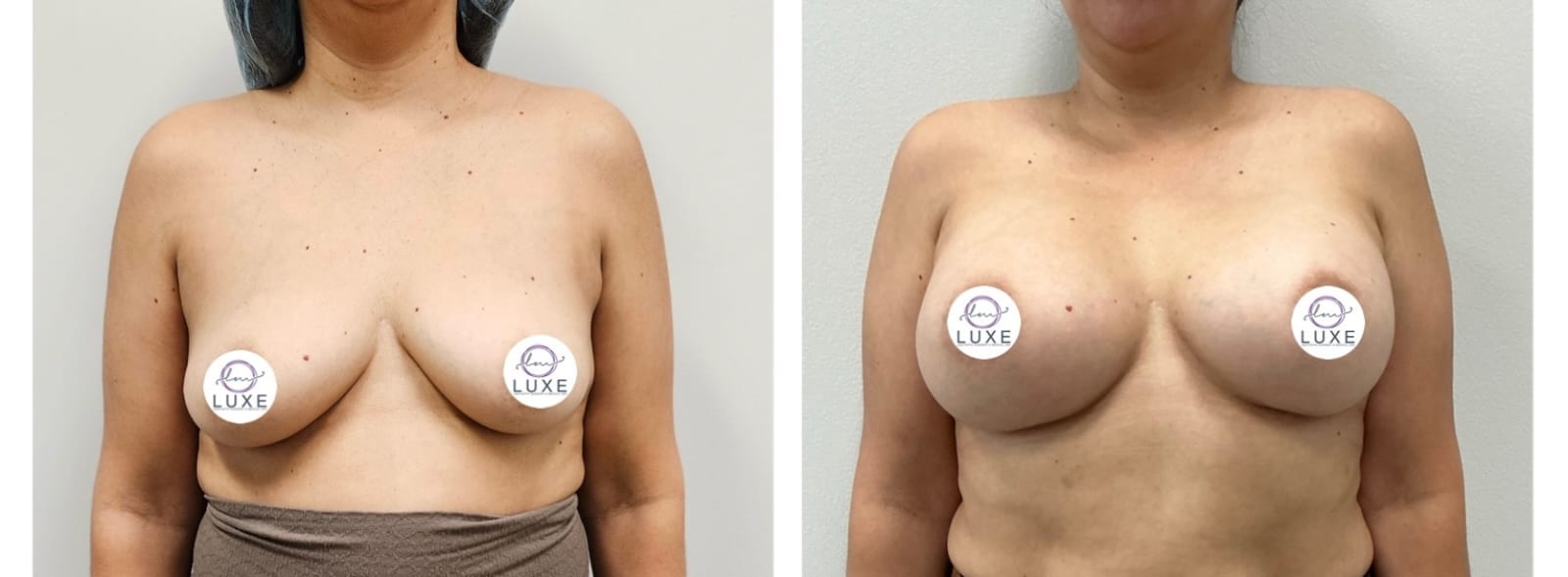 best breast augmentation before after results 2024