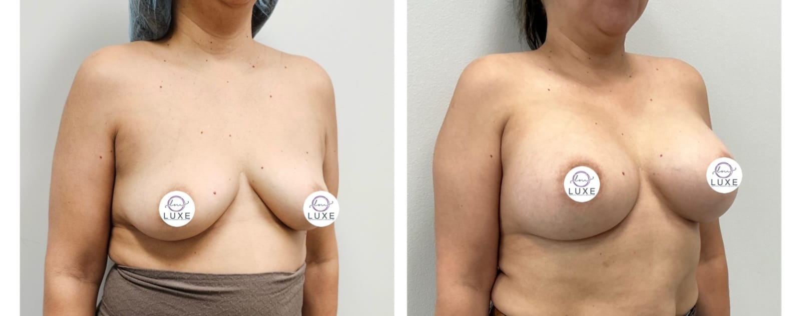 best breast augmentation before after results 2024