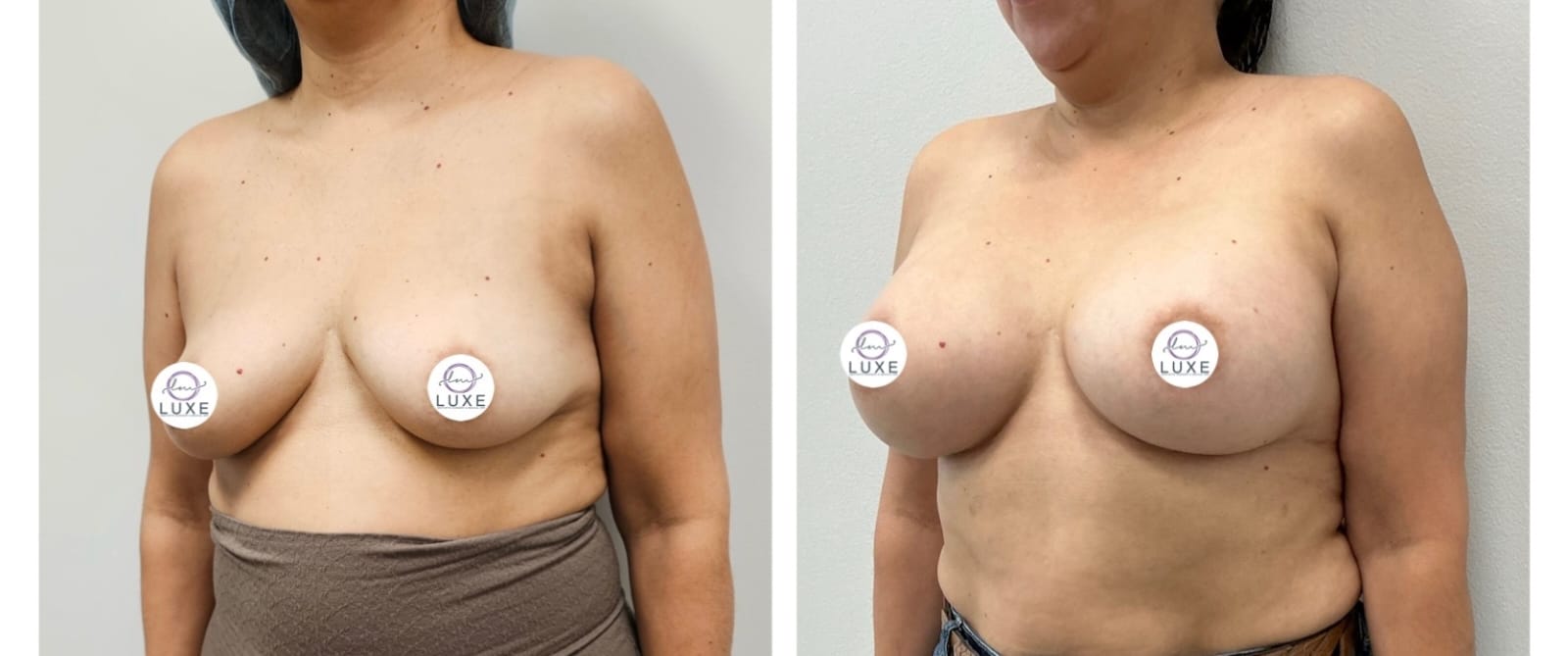 best breast augmentation before after results 2024