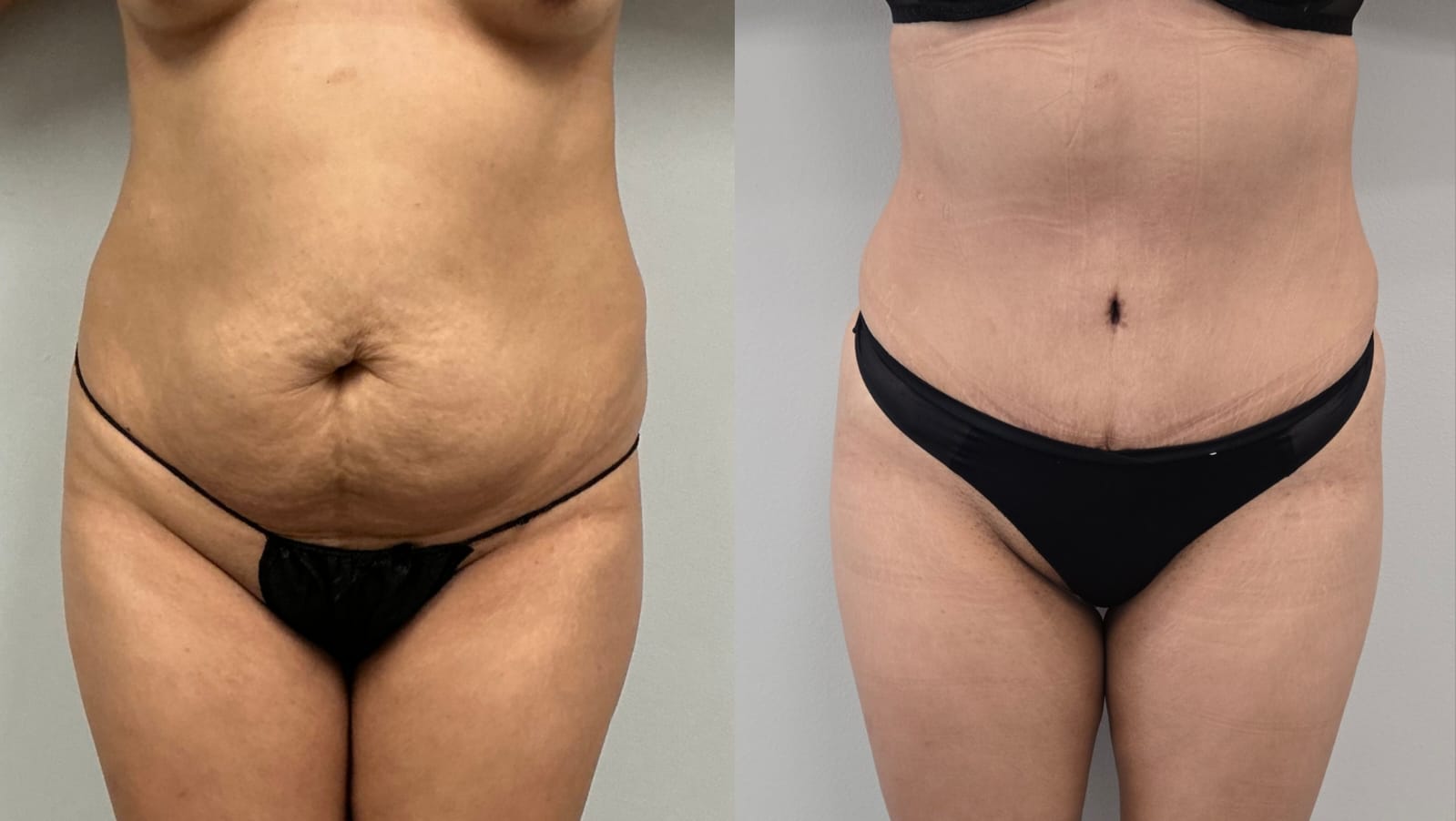 liposuction surgery before after results 2024