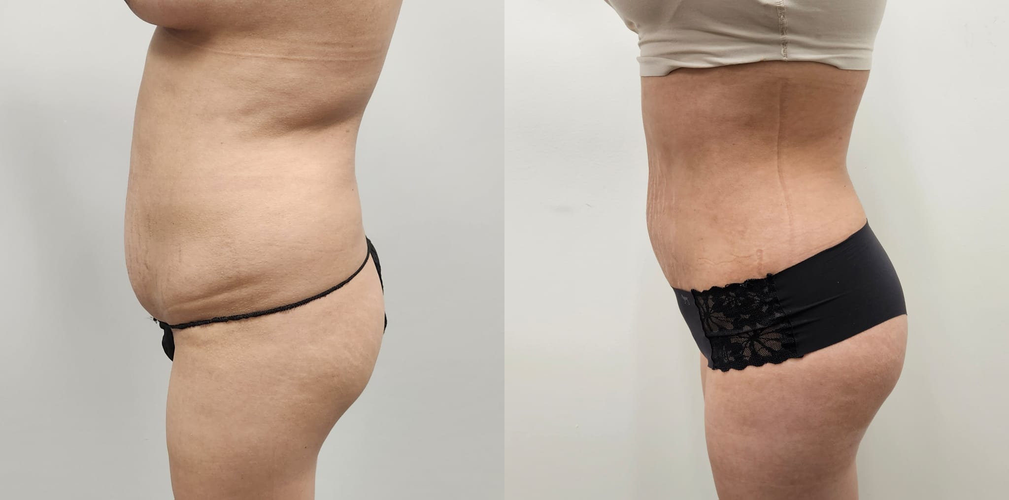 liposuction surgery before after results 2024