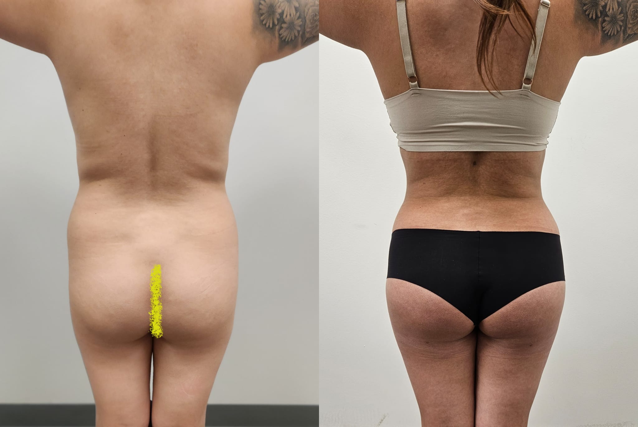 liposuction surgery before after results 2024