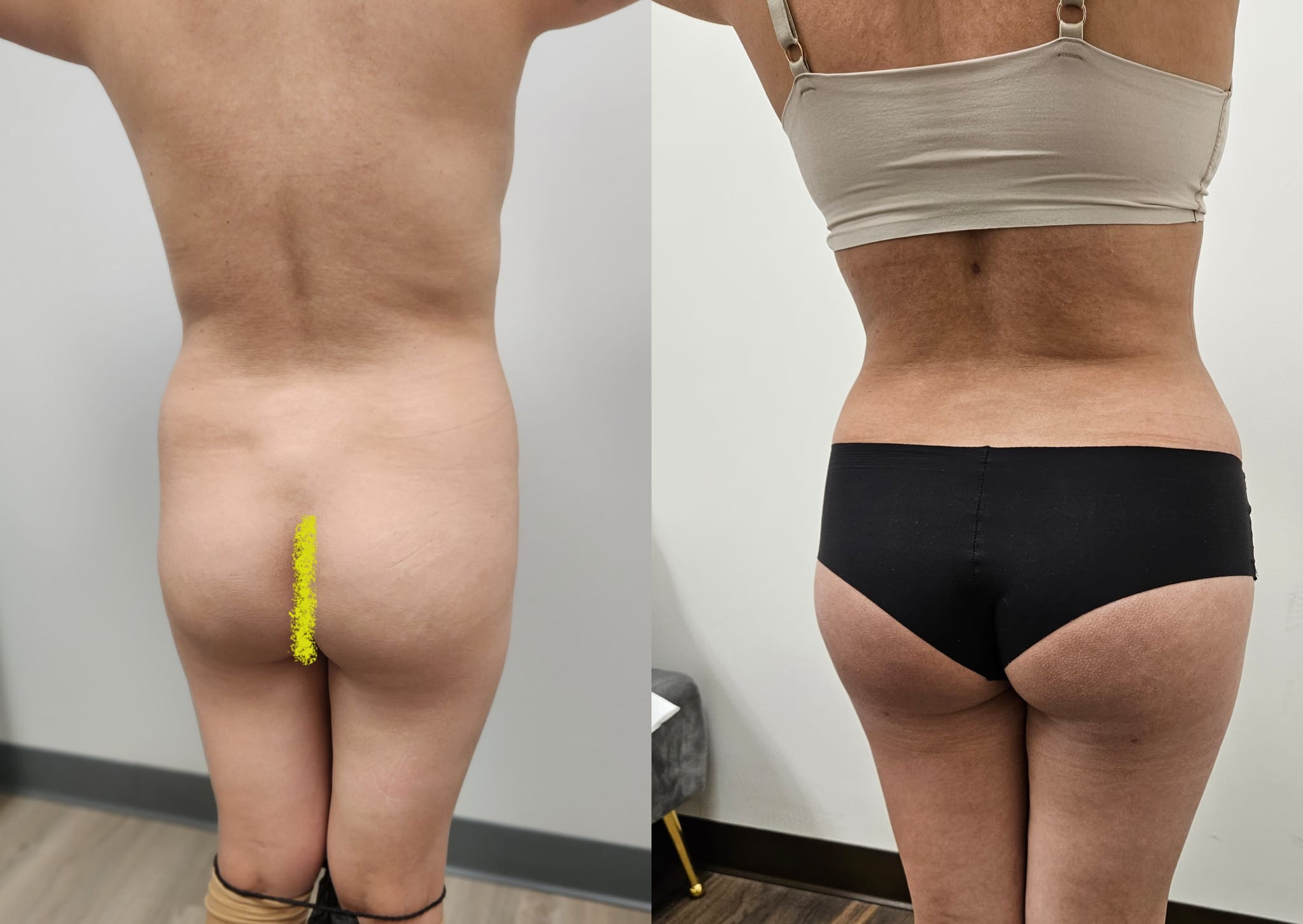 liposuction surgery before after results 2024