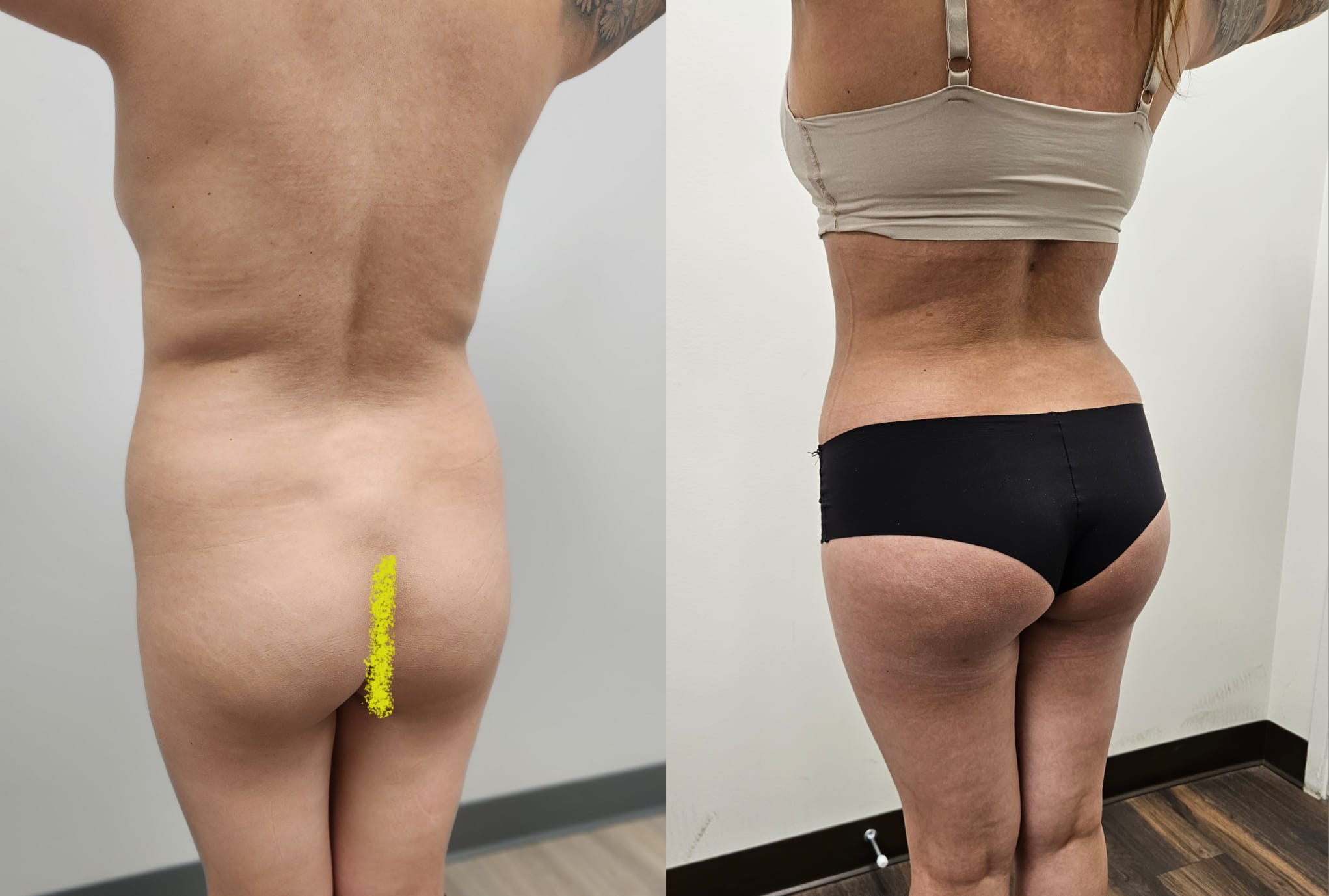 liposuction surgery before after results 2024