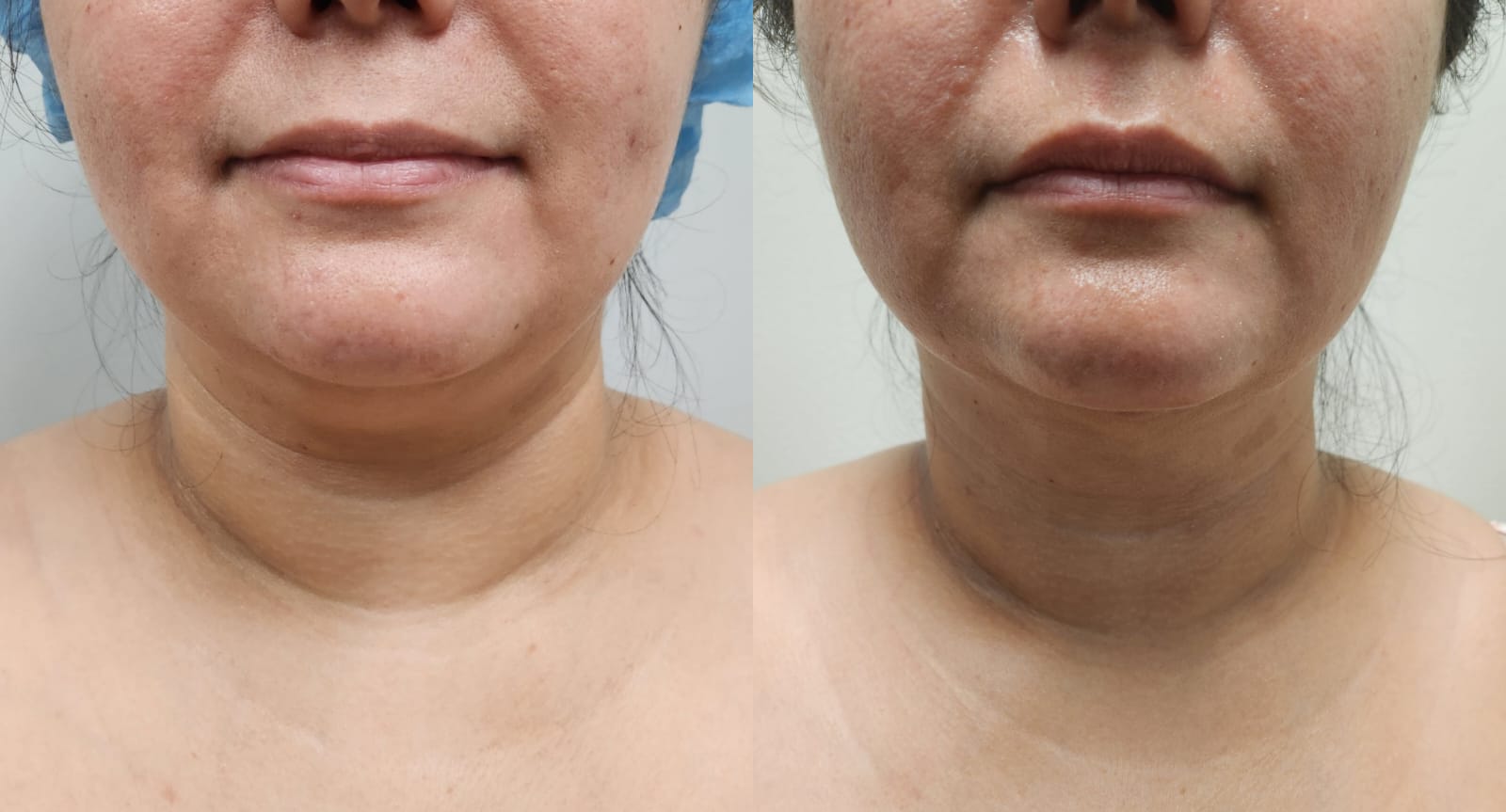 liposuction surgery before after results 2024