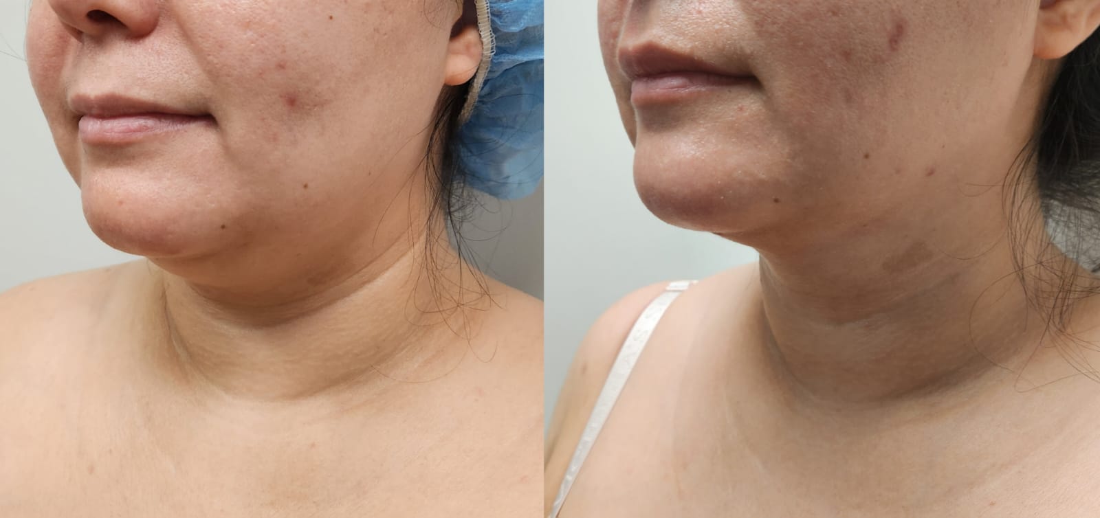 liposuction surgery before after results 2024