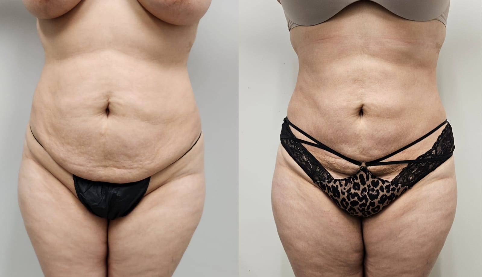 liposuction surgery before after results 2024