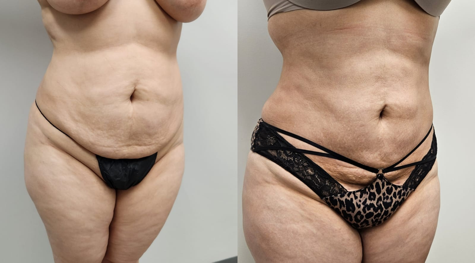 liposuction surgery before after results 2024