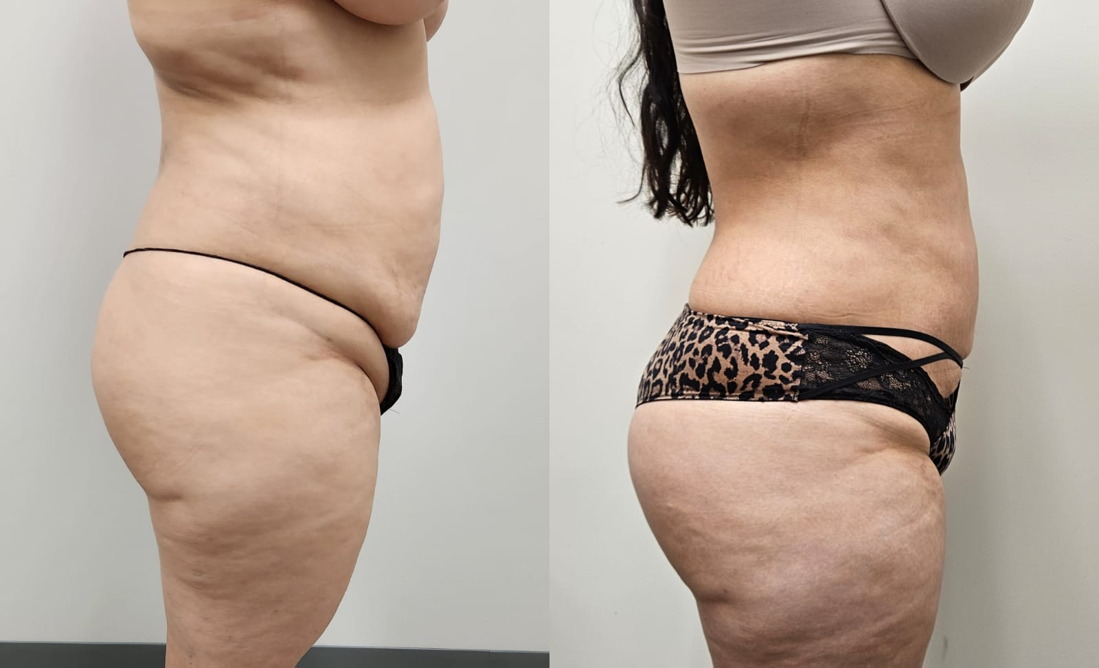 liposuction surgery before after results 2024