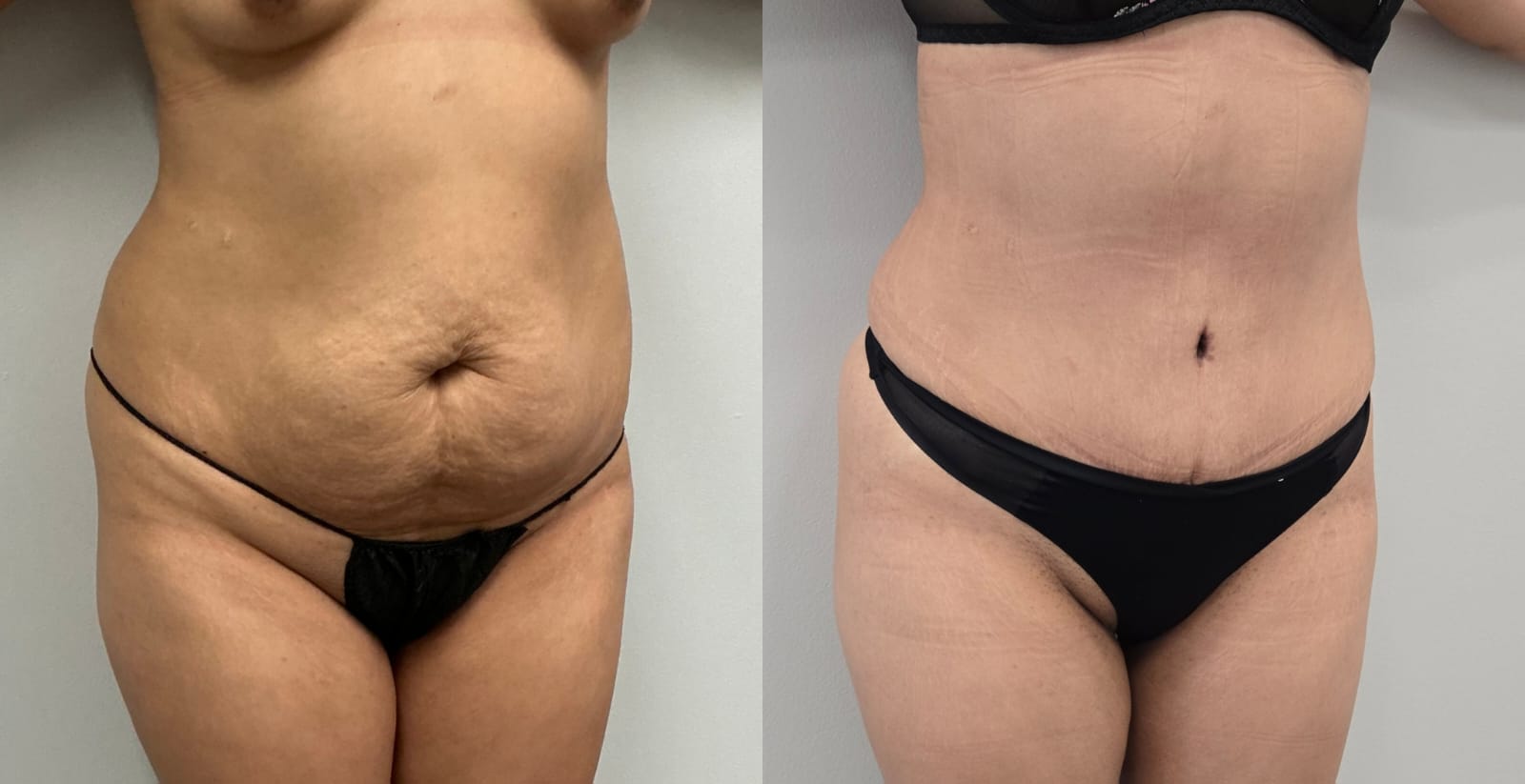 liposuction surgery before after results 2024